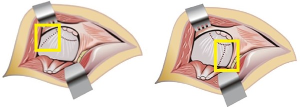 ▲ 관절낭 위쪽을 절개하는 기존 수술법(좌), 관절낭 아래쪽을 절개하는 파이코 수술법(우).
