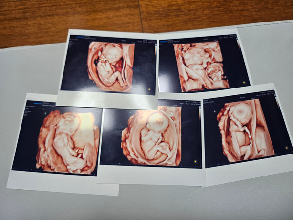▲ 다섯 쌍둥이 초음파 사진. (사진=서울성모병원 제공) /뉴시스