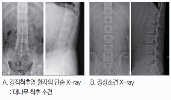 ▲ 강직성척추염 환자의 단순 X-ray와 정상 X-ray.